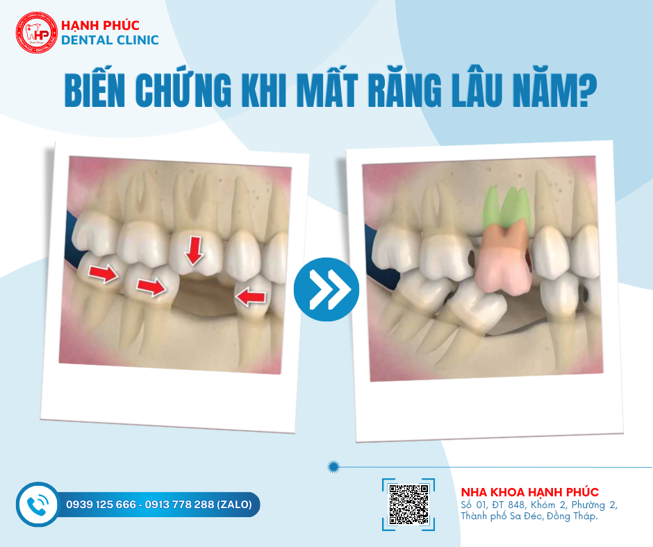 BIẾN CHỨNG NGUY HIỂM KHI MẤT RĂNG LÂU NĂM | Nha khoa Hạnh Phúc - TP. Sa ...