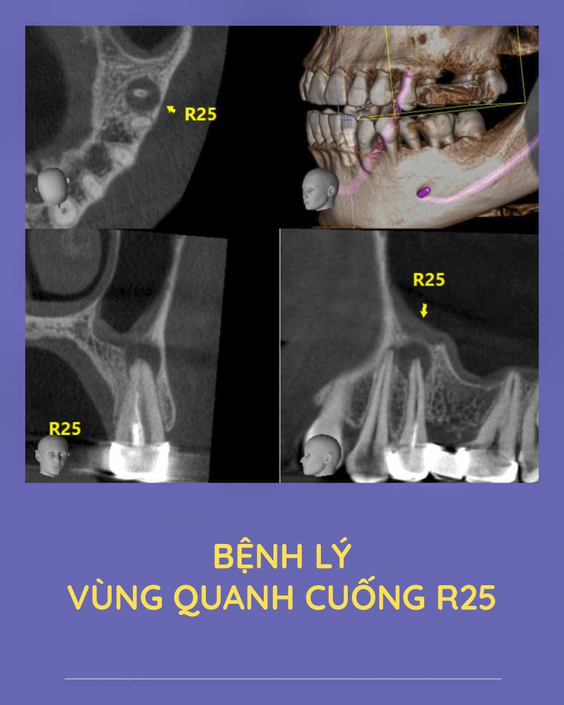 bệnh lý quanh cuống răng 25